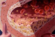 ﻿﻿ холестерин лпнп повышен: что это значит и как его снизить?
